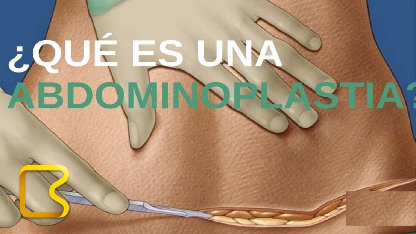 Abdominoplastia O que você precisa saber antes de fazer